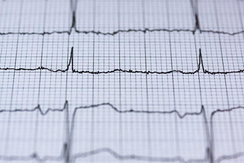 Modulazione della Contrattilità Cardiaca (CCM)