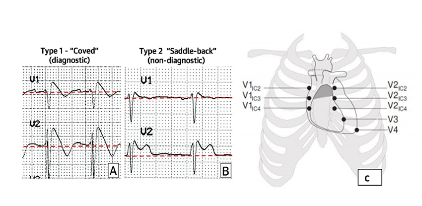 ecg