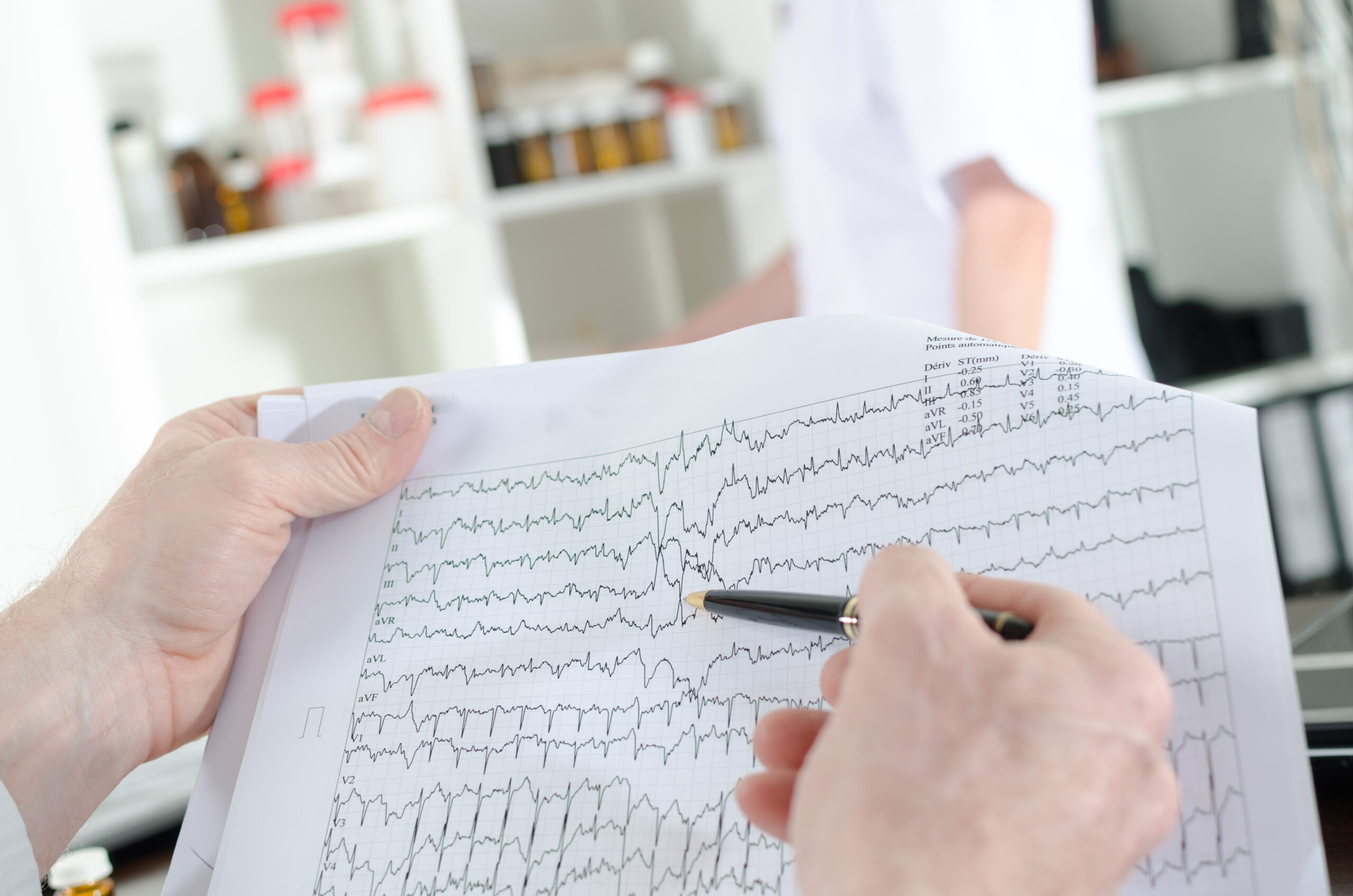 ecg e fibrillazione atriale