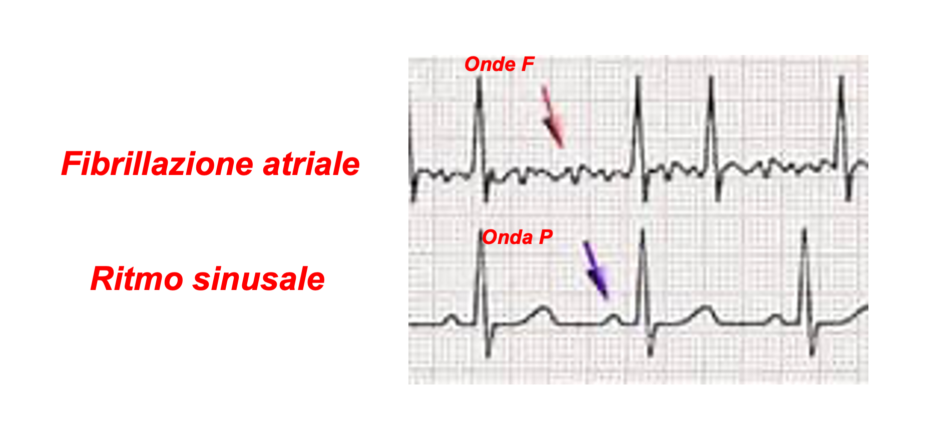 ritmo sinusale e fibrillazione atriale