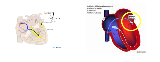 Trattamento per la Sindromedi Wolff Parkinson White