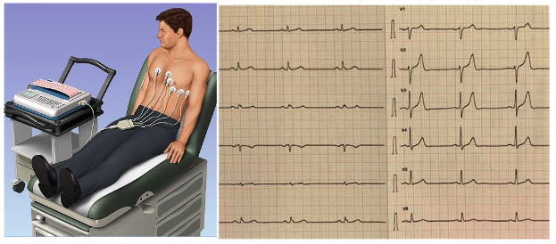 cos'è l'elettrocardiogramma per la visita aritmologica