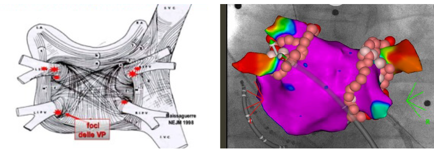 Fig. 1A) Rappresentazione dell’atrio sinistro: nelle zone circostanti gli osti delle vene polmonari sono presenti i foci aritmogeni che danno inizio alla fibrillazione parossisitica.
B) Viene eseguita la disconnessione delle vene polmonari mediante lesioni ablative che isolano elettricamente foci che non trasmettono più  la aritmia all’atrio.