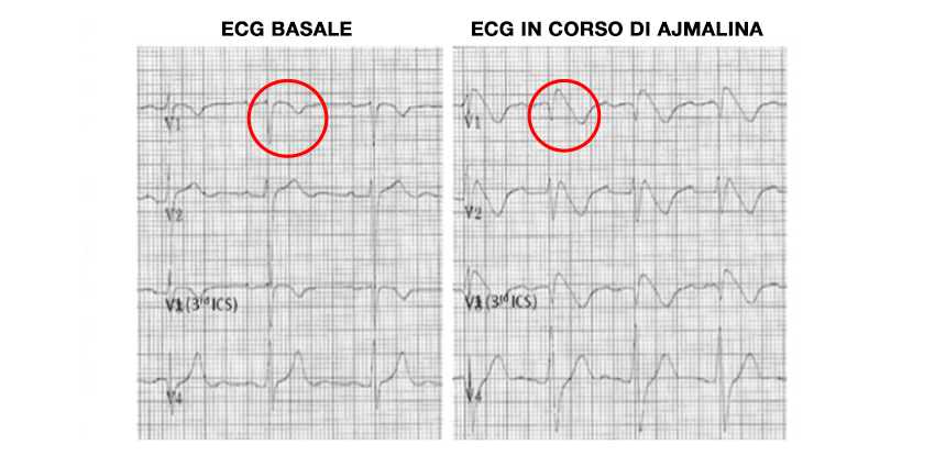 ecg