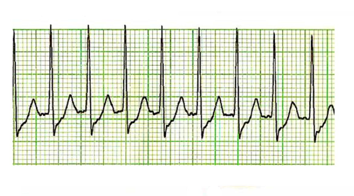 paroxysmal tachycardia