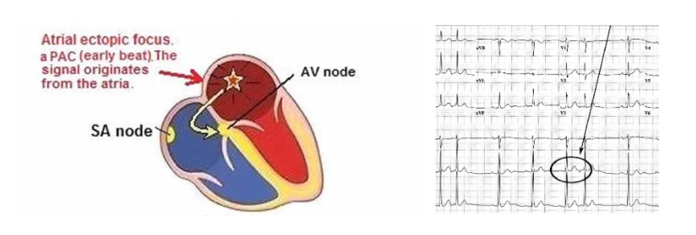 A sinistra la rappresentazione di sede focolaio extrasistolico atriale, a destra registrazione elettrocardiografica di extrasistole atriale.