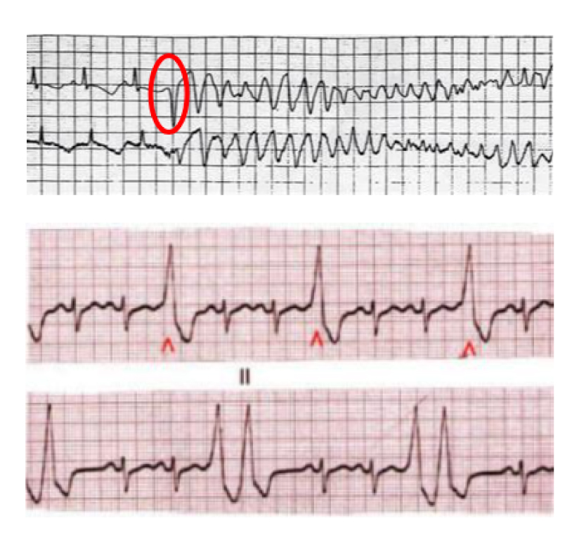 Fig 5: extrasistole ventricolare in presenza di una malattia dei canali ionici(QT lungo) che provoca una aritmia ventricolare prolungata che provoca arresto cardiaco.