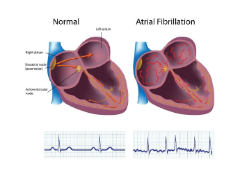 fibrillazione atriale