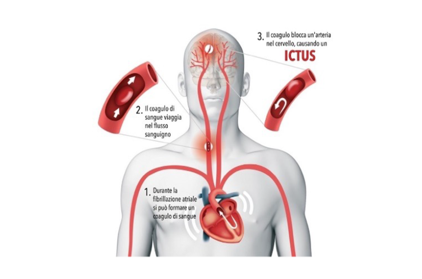 ictus e fibrillazione atriale