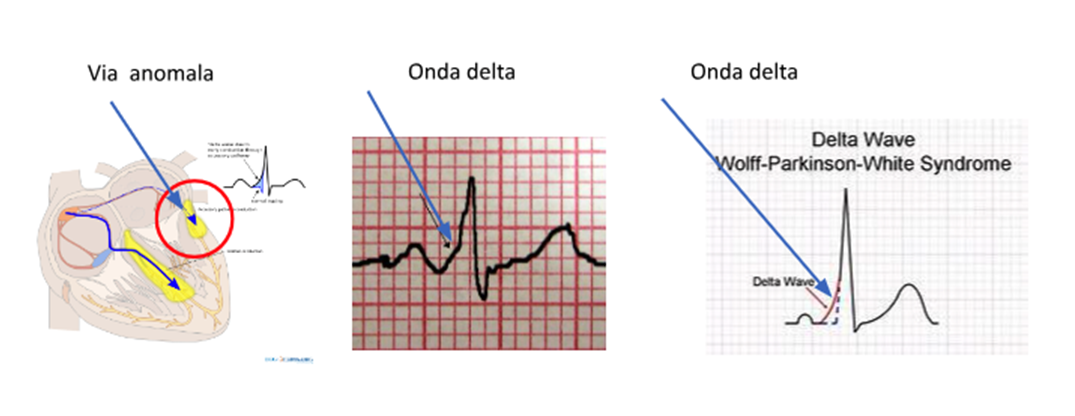 onda delta