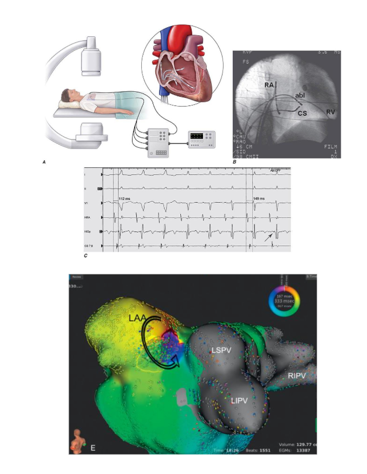 Fig 1 A: Posizionamento degli elettrodi nelle cavità cardiache inserendoli in sede inguinale B: Posizionamento degli elettrodi nelle cavità cardiache immagine radiologicaC: Segnali elettrici registrati mediante gli elettrodi intracardiaci in corso di una aritmia D: Mappa elettroanatomica: si visualizza la camera cardiaca ove ha origine la aritmia .I diversi colori indicano il percorso della aritmia