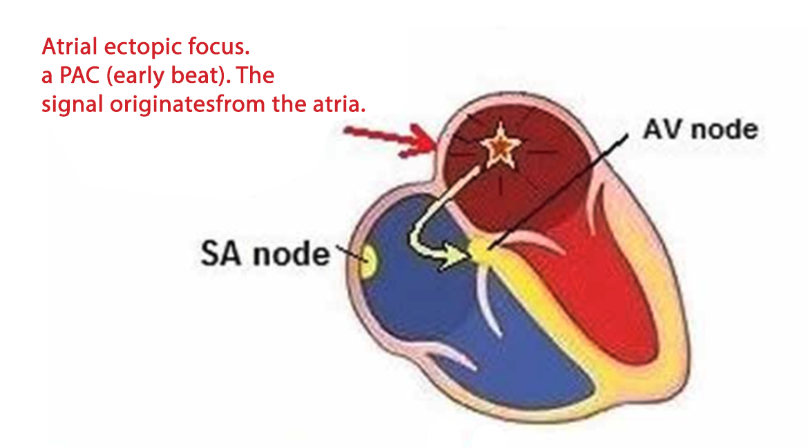 paroxysmal tachycardia